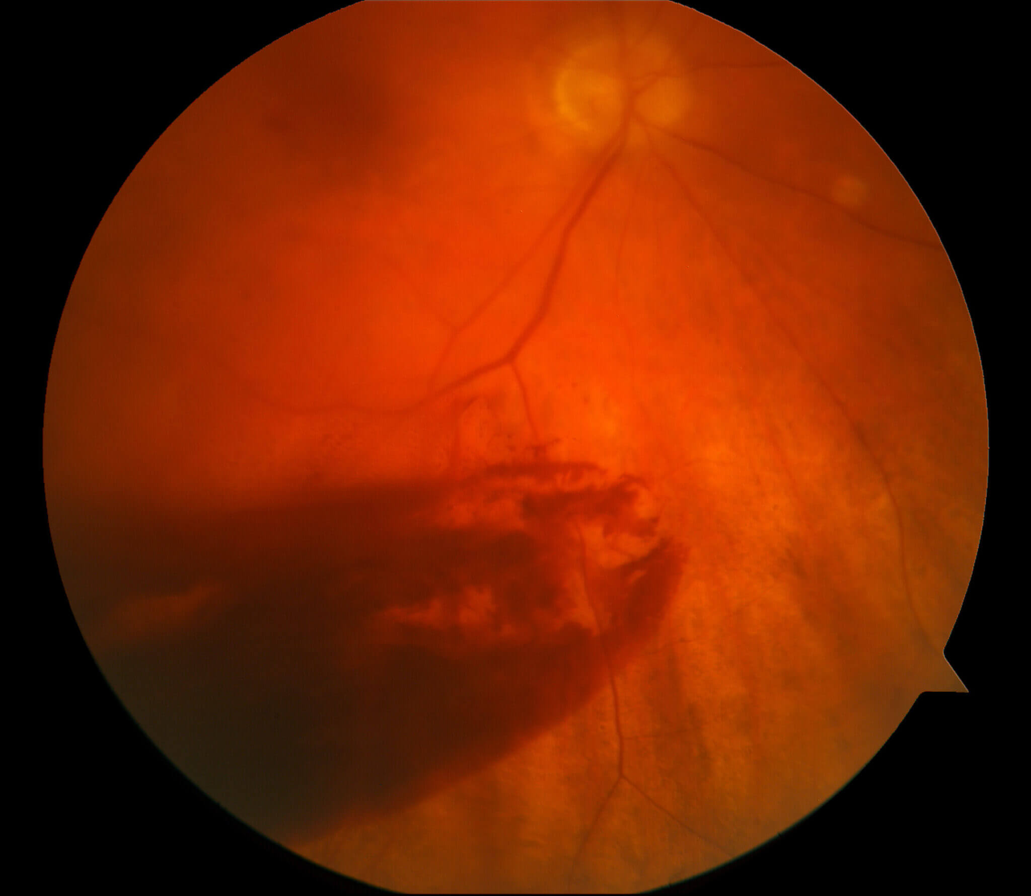 Vitreous Hemorrhages - Retina Consultants Of Michigan